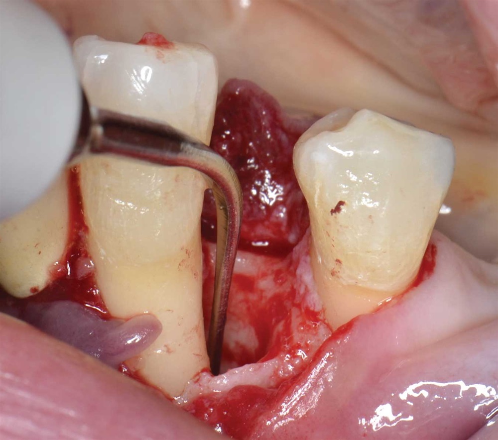 Tarquini_Periodontal intrabony defect